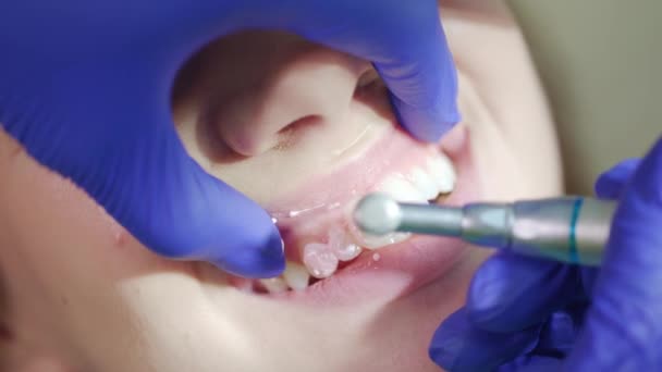 Profesional retirando placa dental en consultorio dental. Cerrar dientes pulido — Vídeos de Stock
