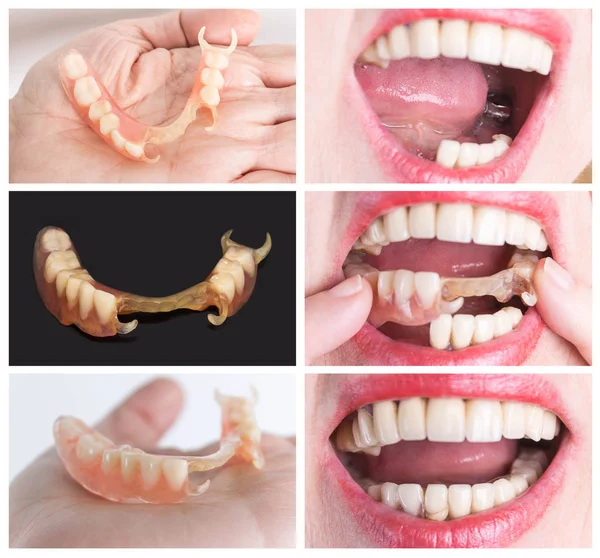 Rehabilitasi gigi dengan prostesis atas dan bawah, sebelum dan setelah pengobatan — Stok Foto