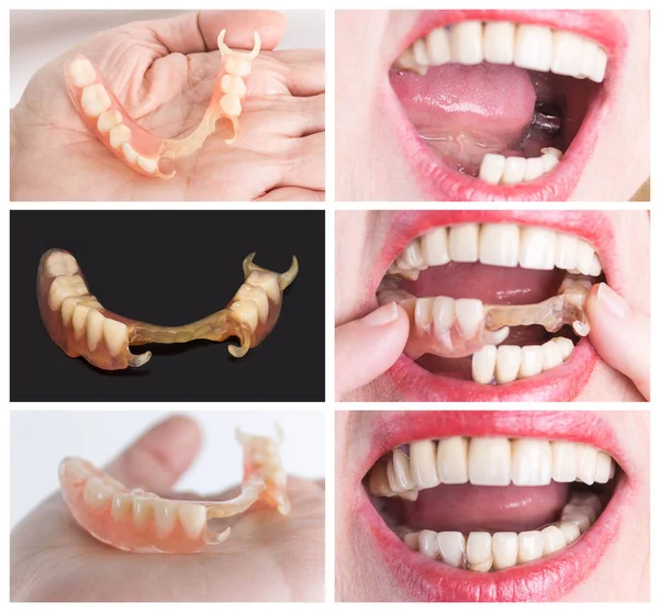 Reabilitação dentária com prótese superior e inferior, antes e após o tratamento — Fotografia de Stock