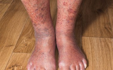 Varisli damarlar ile cilt Close-Up