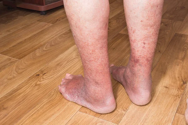 Close-up of skin with varicose veins — Stock Photo, Image