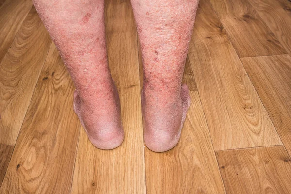 Close-up of skin with varicose veins — Stock Photo, Image
