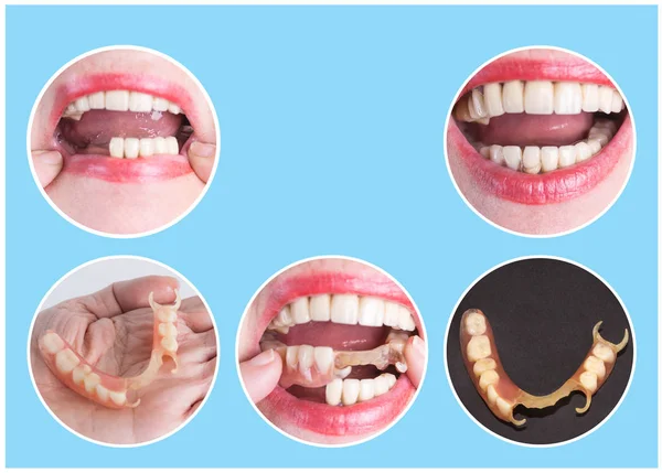 Rehabilitación dental con prótesis superior e inferior, antes y después del tratamiento —  Fotos de Stock