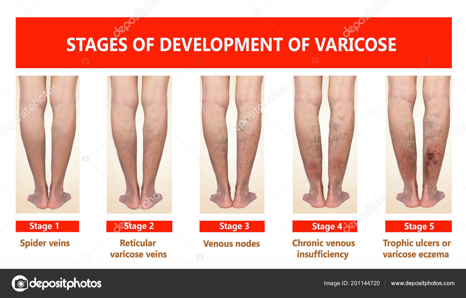 Varicose veins on a female senior leg Stock Photo by ©Marina113
