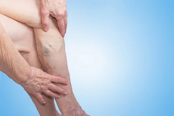 As veias varicosas em umas pernas da velha mulher no azul — Fotografia de Stock