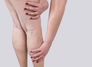 The varicose veins on a legs of woman clipart
