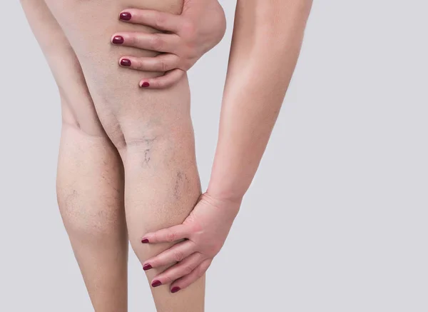 The varicose veins on a legs of woman — Stock Photo, Image