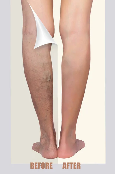 Treatment of varicose before and after. Varicose veins on the senior female legs.