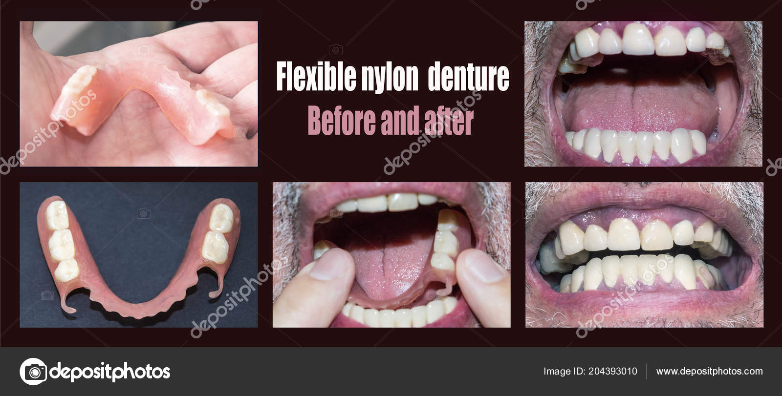 Dental rehabilitation with upper and lower prosthesis, before and after