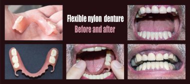 Dental rehabilitation with upper and lower prosthesis, before and after treatment clipart