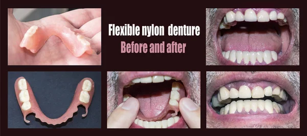 Reabilitação dentária com prótese superior e inferior, antes e após o tratamento — Fotografia de Stock