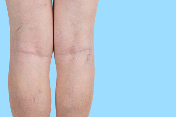 The varicose veins on a legs of woman