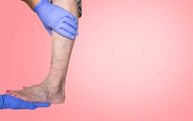 Lower limb vascular examination because suspect of venous insufficiency clipart