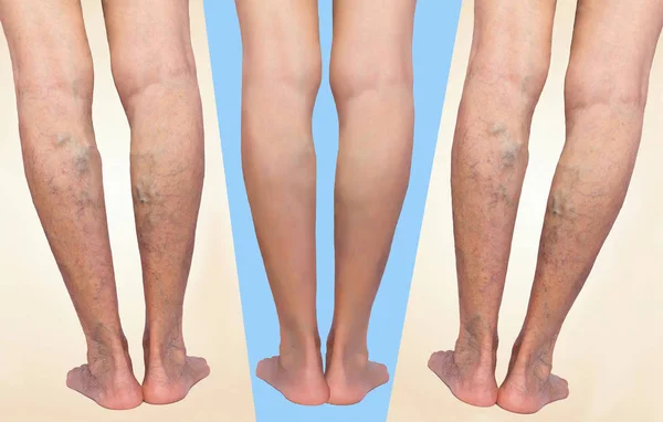 Лечение варикозного расширения до и после. Варикозные вены на ногах
. — стоковое фото