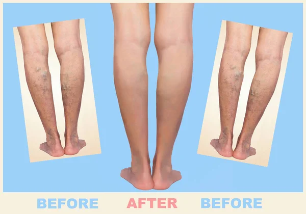Tratamiento de la varicosa antes y después. Venas varicosas en las piernas . — Foto de Stock
