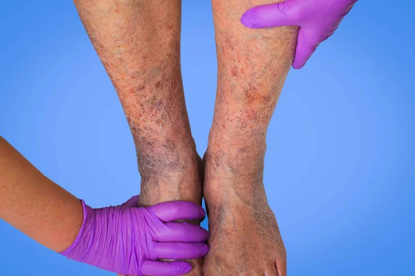 Close-up of skin with varicose veins — Stock Photo, Image