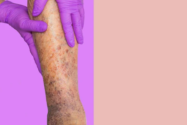 Närbild av huden med åderbråck — Stockfoto
