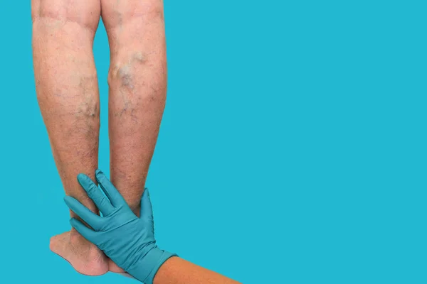 The varicose veins on a legs of old woman on blue — Stock Photo, Image