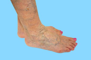 Bir kadın ayak üzerinde varisli damarlar