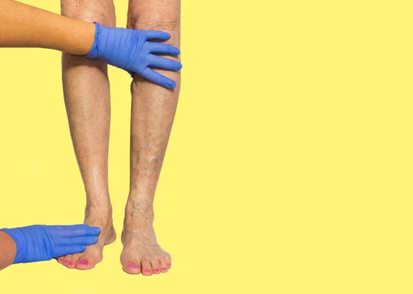 Варикозне розширення вен на ногах жінки — стокове фото