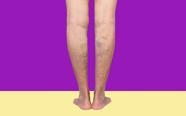 Varices sur les jambes d'une femme — Photo