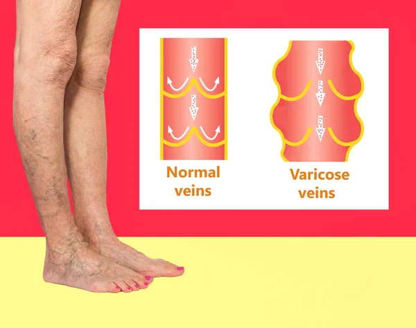 Varices sur les jambes d'une femme âgée. La structure des veines normales et des varices — Photo