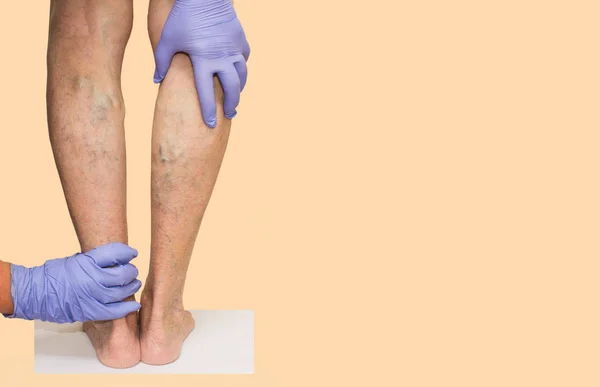 Venas varicosas en piernas femeninas —  Fotos de Stock