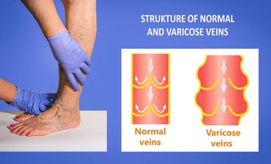 Varicose veins on a female senior legs. The structure of normal and varicose veins clipart