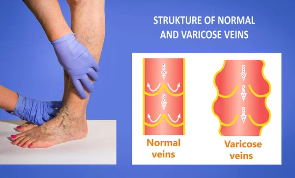 Yaşlı bir kadının bacaklarında varis damarları var. Normal ve varisli damarların yapısı — Stok fotoğraf