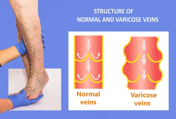 Yaşlı bir kadının bacaklarında varis damarları var. Normal ve varisli damarların yapısı — Stok fotoğraf