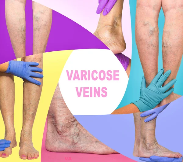 The female legs with veins varicose spider. Collage