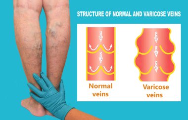 Yaşlı bir kadının bacaklarında varis damarları var. Normal ve varisli damarların yapısı