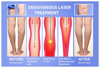 Varicose Veins and laser clipart