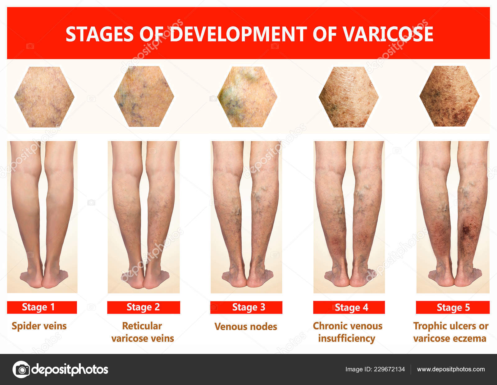 Varicose Veins Female Senior Legs Stages Varicose Veins Old Age