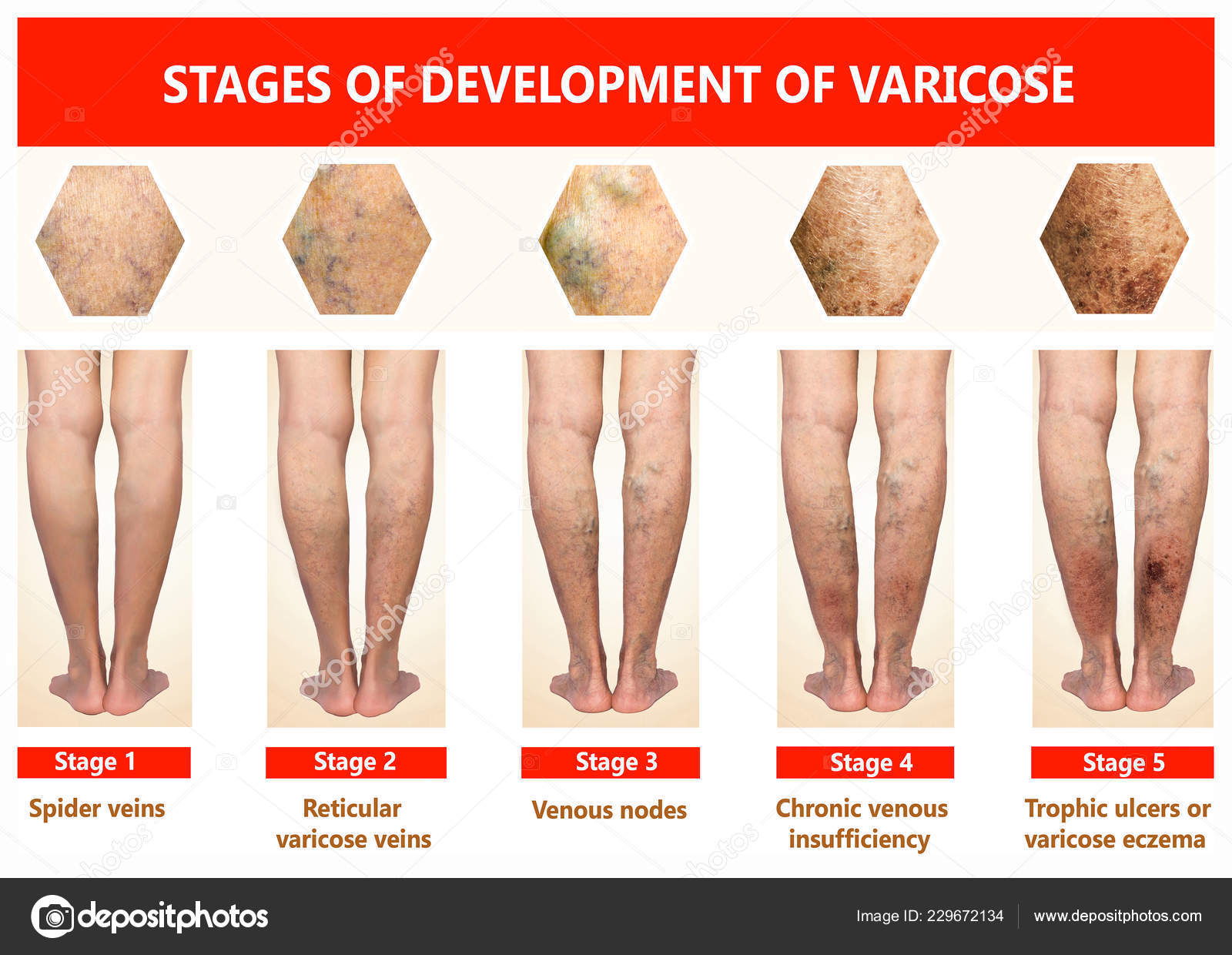 hematologie i vene varicoase