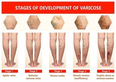 Varis bir kadın kıdemli ayak üzerinde. Varis aşamaları. Yaşlılık ve hasta bir kadın. Varis yaşlı kadın bir ayak üzerinde. Varisler, varis, ödem, hastalık kavramı