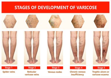 Varicose veins on a female senior legs. The stages of varicose veins. The old age and sick of a woman. Varicose veins on a legs of old woman. The varicosity, spider veins, edema, illness concept clipart