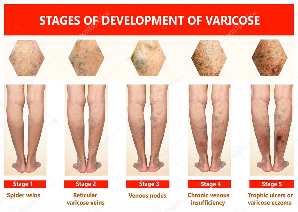 Varicose veins on a female senior legs. The stages of varicose veins. The old age and sick of a woman. Varicose veins on a legs of old woman. The varicosity, spider veins, edema, illness concept