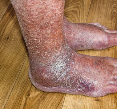 Varisli damarlar ile cilt Close-Up