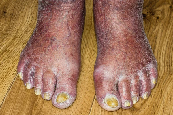 Fungus Infection on Nails of Mans Foot — Stock Photo, Image