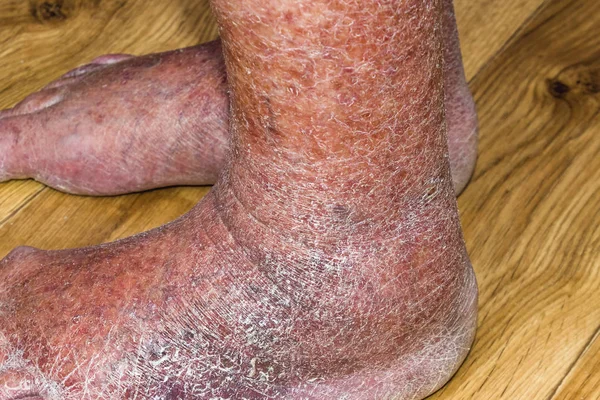 Primo piano della pelle con vene varicose — Foto Stock