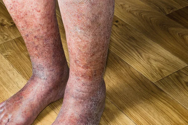 Close-up of skin with varicose veins — Stock Photo, Image