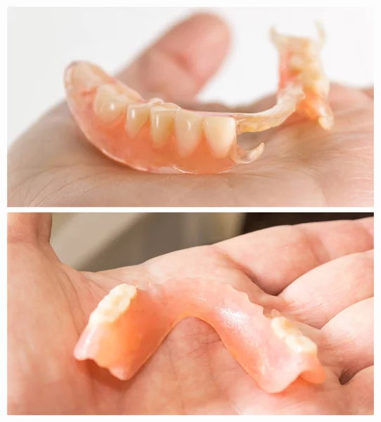 Flexible nylon denture — Stock Photo, Image
