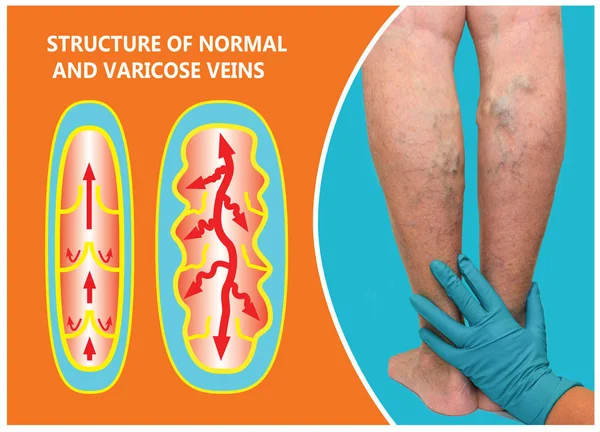 Varicose veins on a female senior legs. The structure of normal and varicose veins.