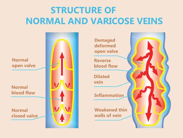 The varicose veins and normal veins