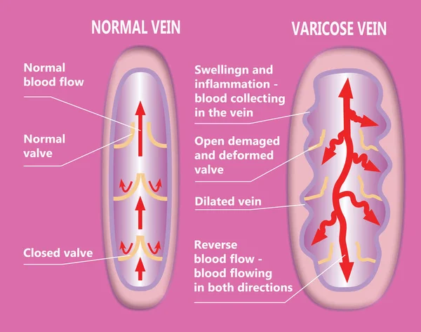 Les varices et les veines normales — Photo