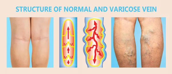 여자의 윗 다리에 정맥 이 있어. 정맥류와 정맥류 정맥의 구조. — 스톡 사진