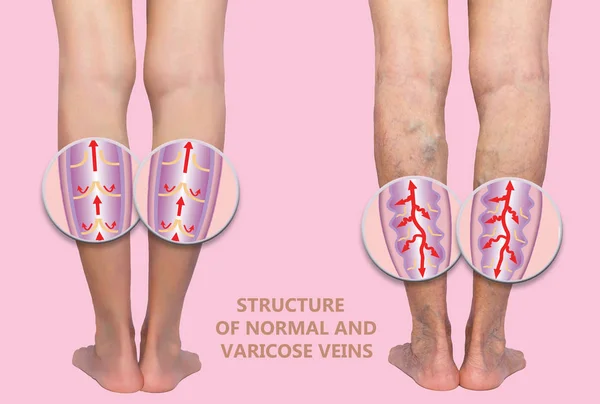 여자의 윗 다리에 정맥 이 있어. 정맥류와 정맥류 정맥의 구조. — 스톡 사진