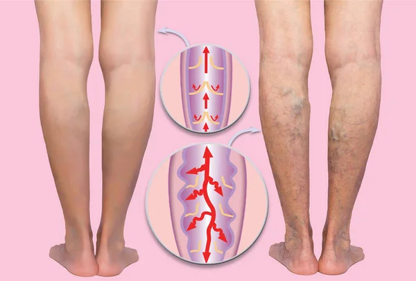 여자의 윗 다리에 정맥 이 있어. 정맥류와 정맥류 정맥의 구조. — 스톡 사진