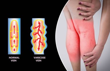 Yaşlı bir kadının bacaklarında varis damarları var. Normal ve varisli damarların yapısı.
